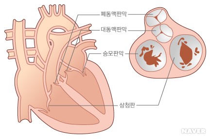 심장판막의 종류 (출처 : 서울대학교병원 의학정보)