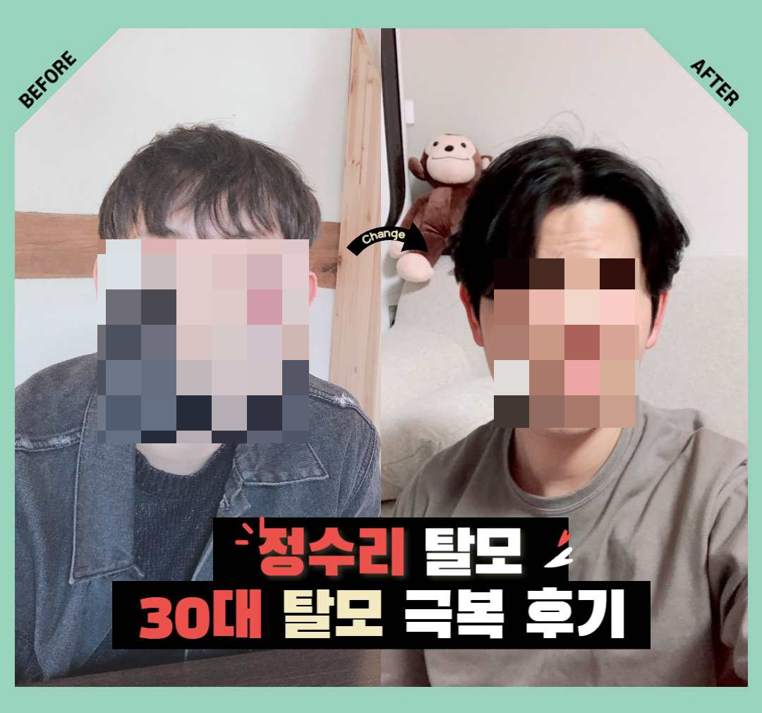  [탈모 치료 후기] 30대 정수리 원형 탈모 유전 극복 (한의원 / 충북대 병원 / 약)
