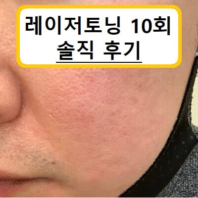 레이저토닝-10회-후기-썸네일