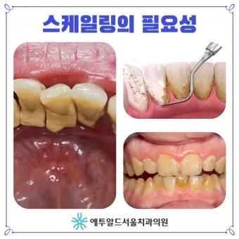 스케일링 후 양치 통증 음식_3