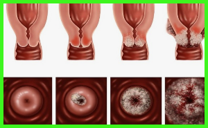 자궁 경부암 원인 증상 치료 및 예후 재발과 사망률