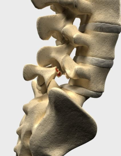 척추 전방 전위증(Spinal Spondylolisthesis)