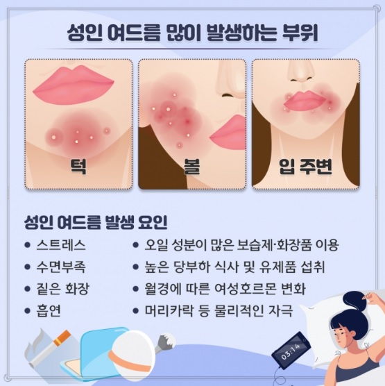 성인 여드름 발생 부위