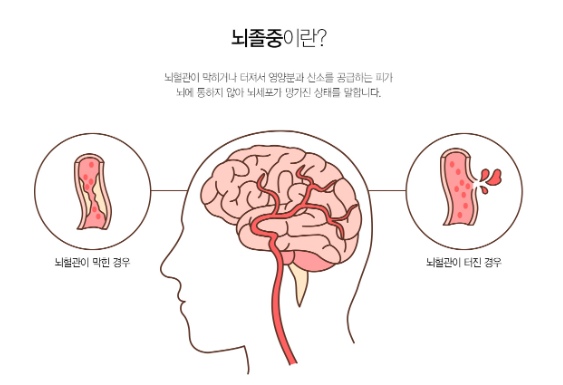 뇌졸중의 위험성과 예방 방법