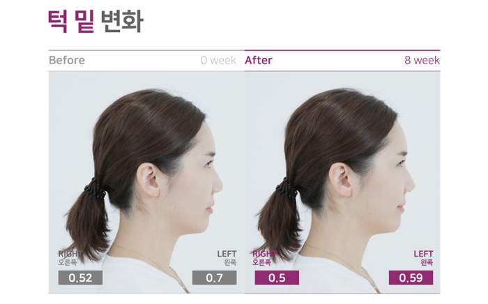 입가주름 4