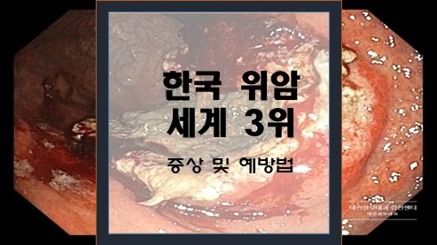 한국-위암-세계-3위