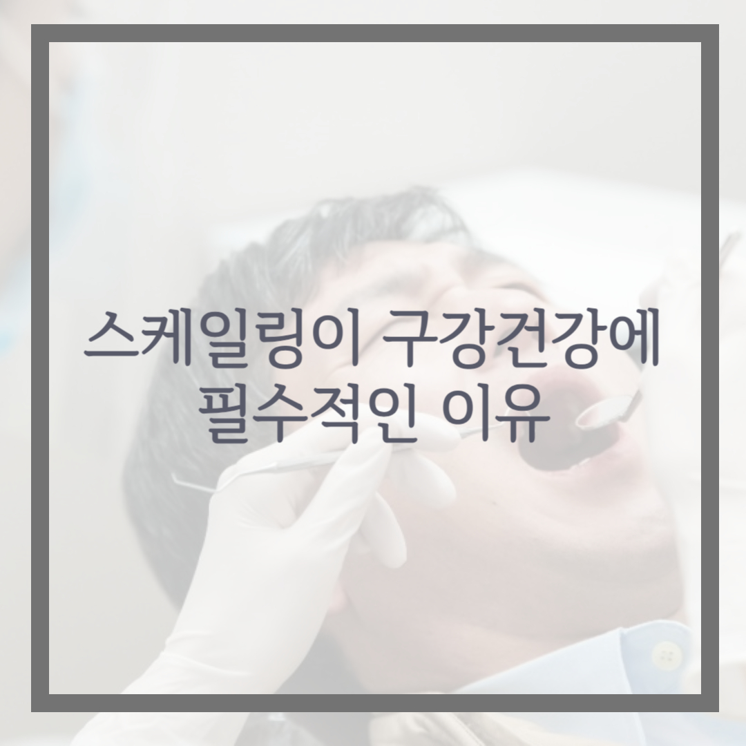 스케일링이 구강 건강에 필수적인 이유