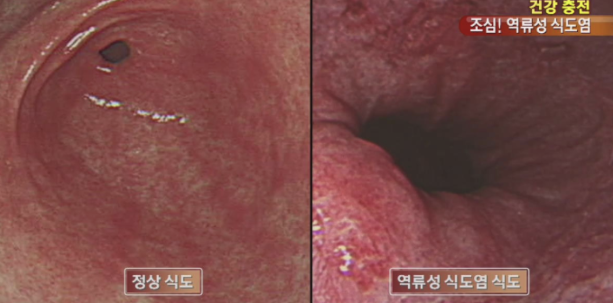 역류성 식도염&#44; 정상 식도