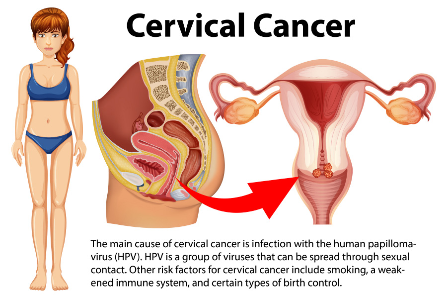 자궁경부암(cervical-cancer-infographic-with-explanation) 이미지 사진