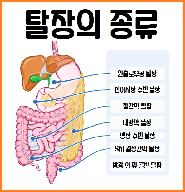 탈장 완전 가이드: 증상부터 수술까지