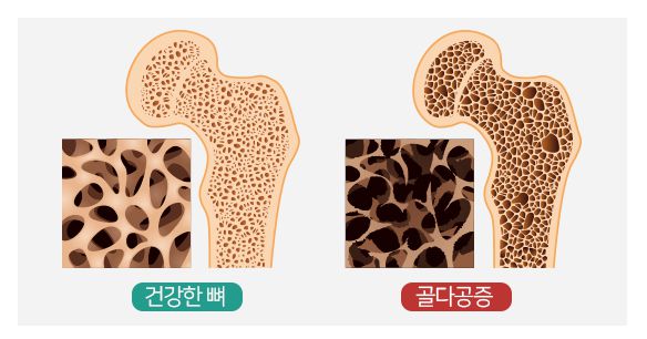  골다공증 치료방법 5가지, 검사비용 및 주사 부작용