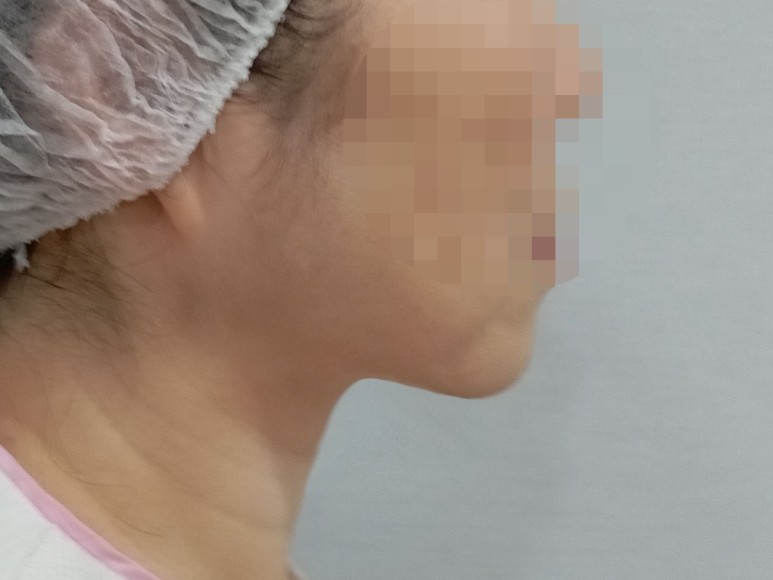 얼굴지방흡입 얼굴지방이식 안면윤곽수술 얼굴필러 얼굴보형물 얼굴성형 부작용 효과 붓기 멍 이중턱지방흡입