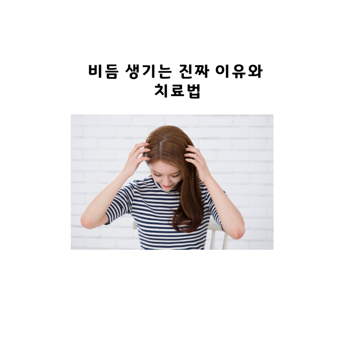 비듬 생기는 진짜 이유와 치료법