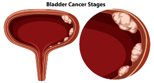 Safety Tips for Healthy Aging: Understanding and Preventing Bladder Cancer Symptoms.