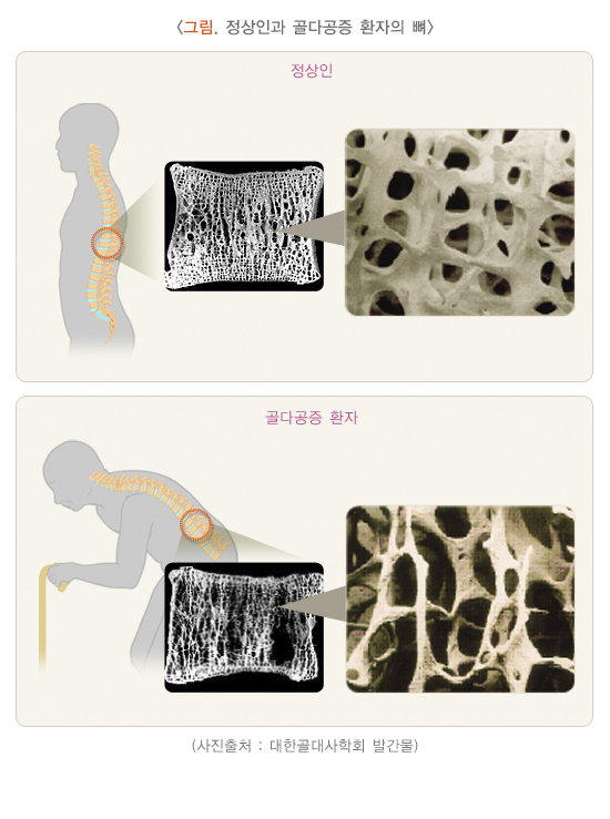 골다공증 환자의 뼈