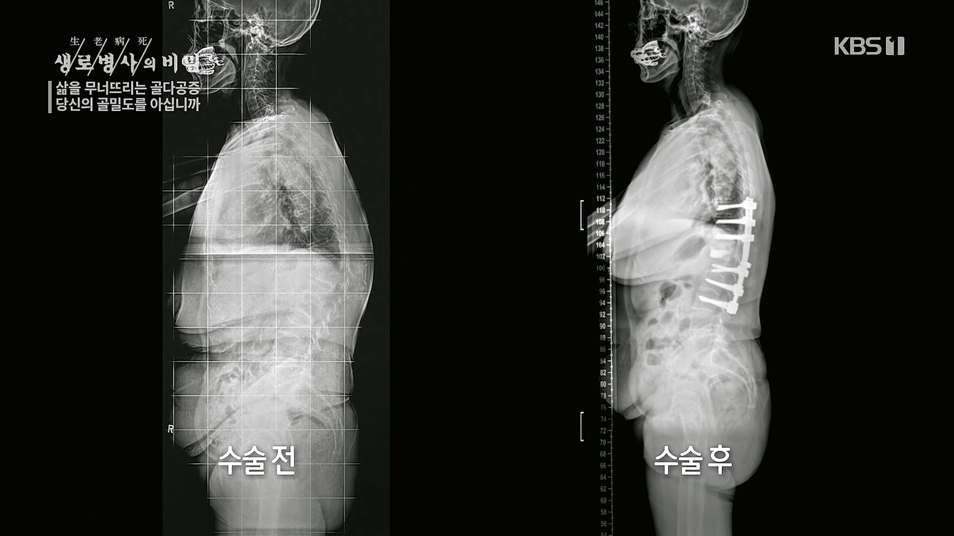 생로병사의 비밀.E852.230118p.H264-F1RST.mp4_20230120_200315.130.jpg