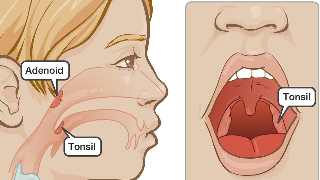 편도(tonsil) 위치