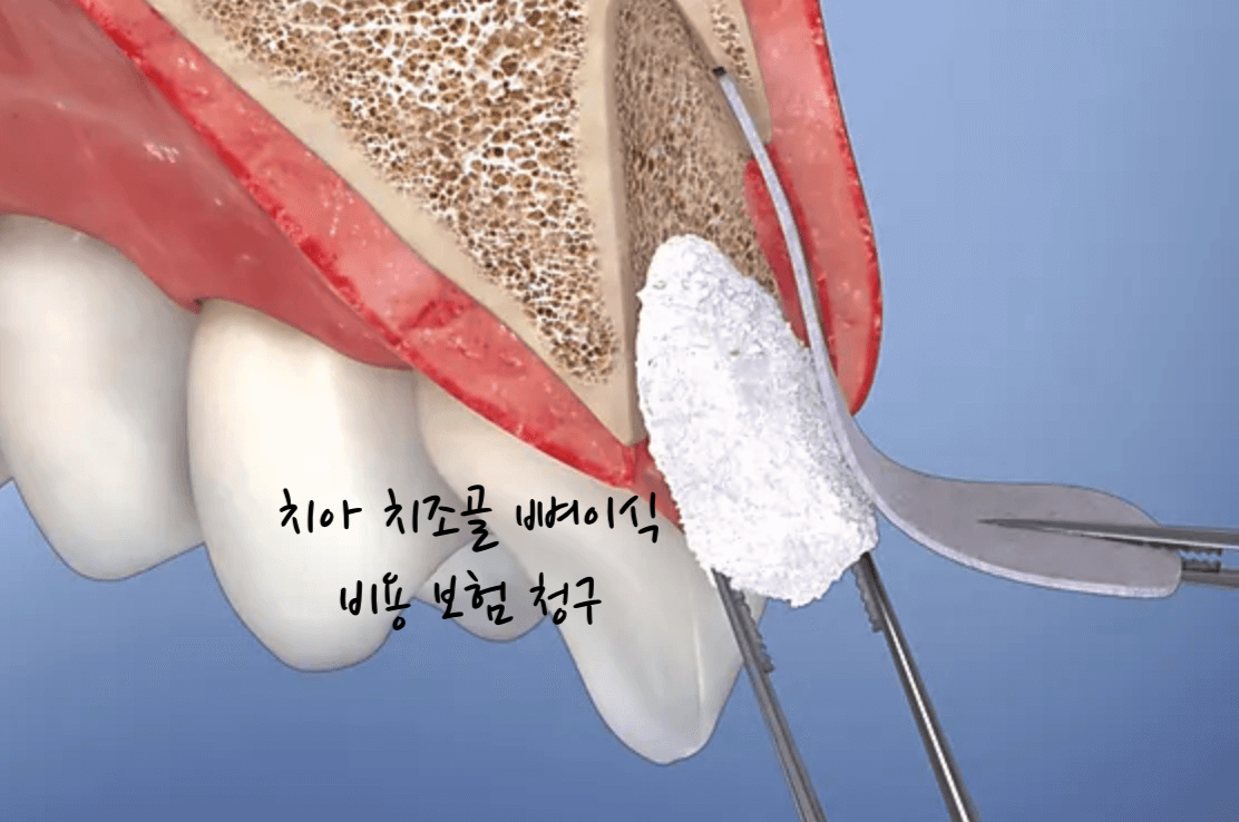 치아 치조골 뼈이식