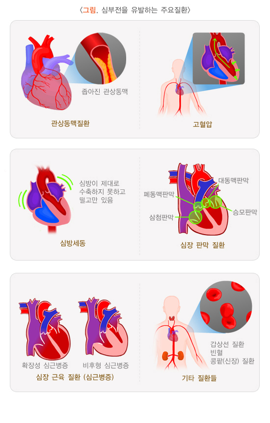  심부전 증상과 원인 및 치료