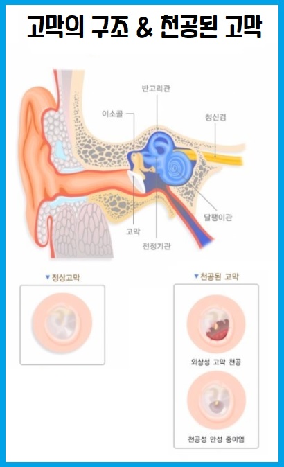 고막 구조 천공고막