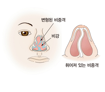 비중격만곡증