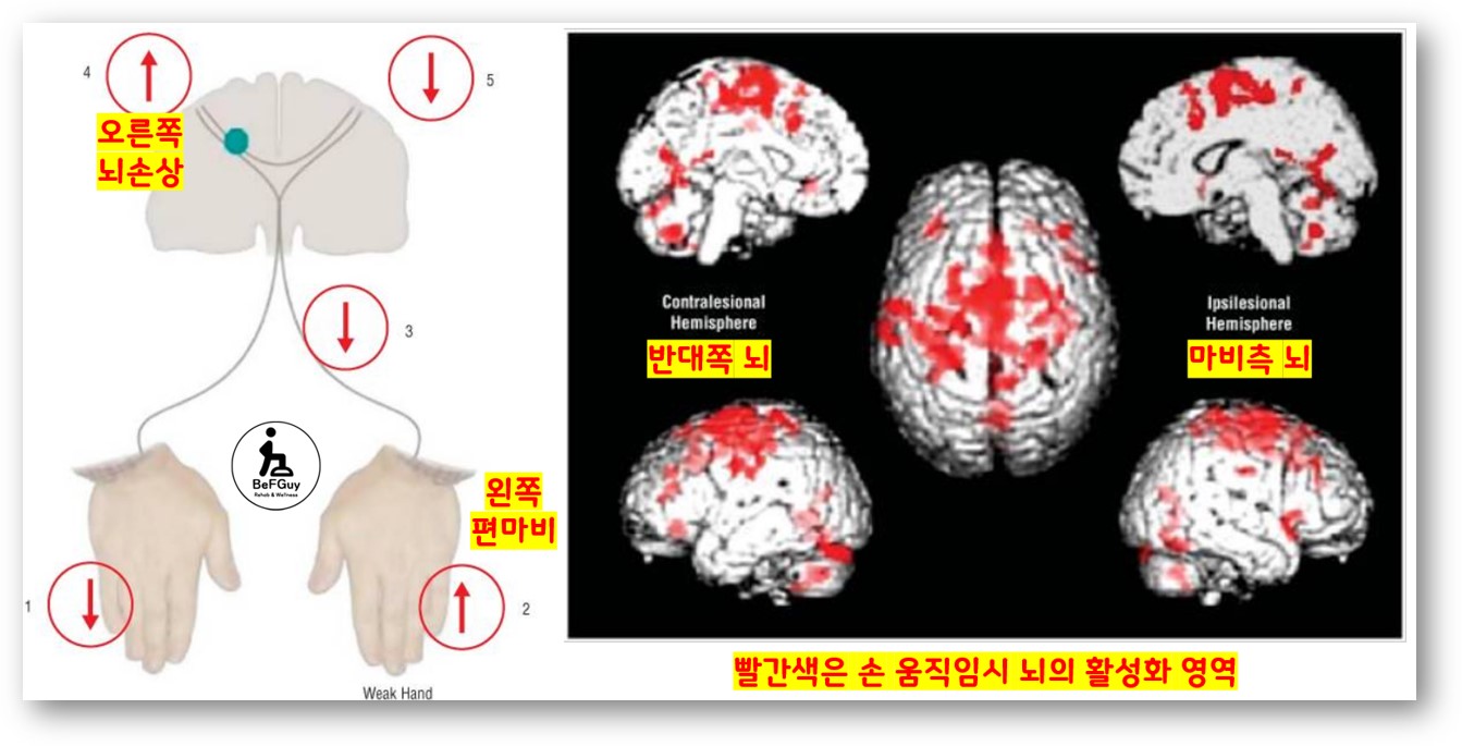 뇌졸중 이후 우리 몸의 회복기전