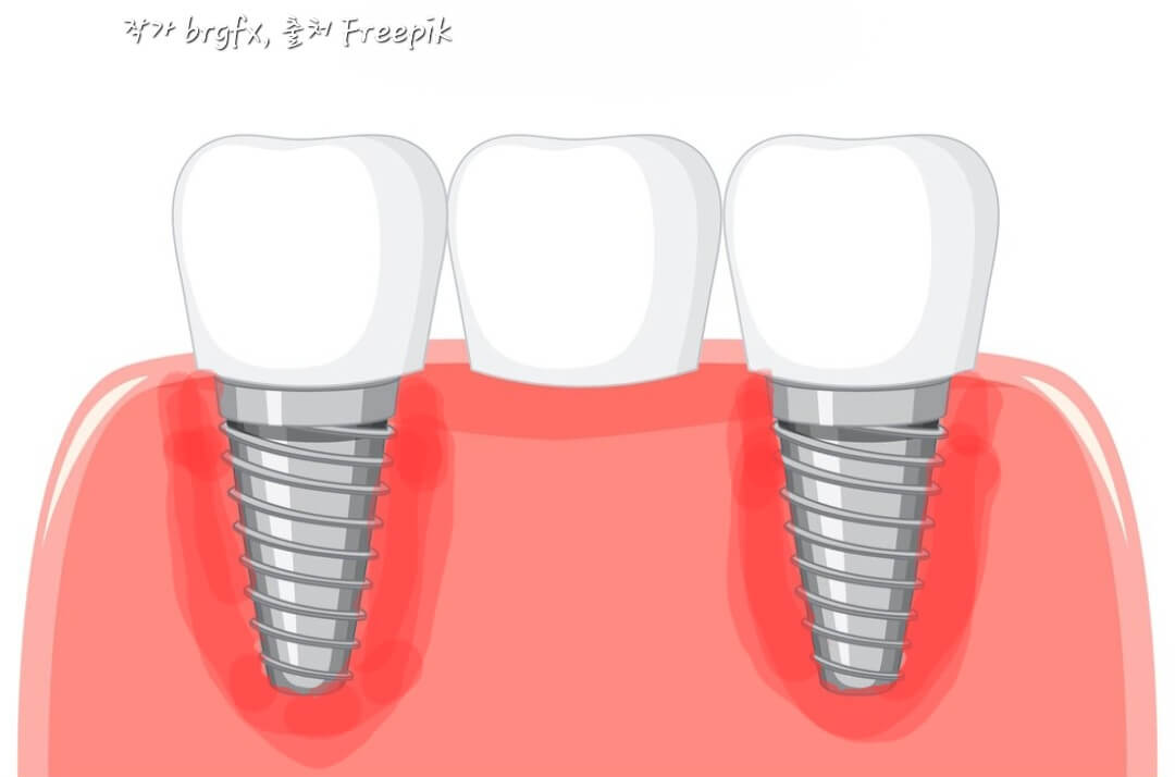 임플란트 주위염