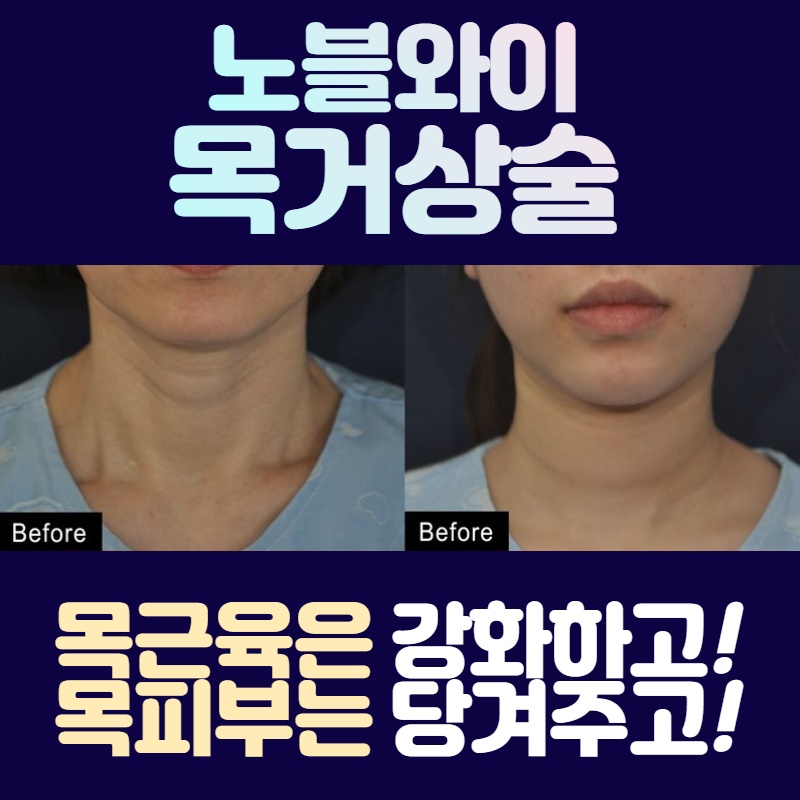  목거상술후기 정면측면 모두 말끔해?