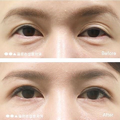 눈꺼풀을 어려 보이게 만드는 방법 5