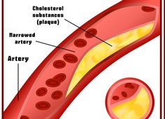 혈관여드름개선