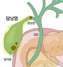 오른쪽-옆구리-통증-의심되는-병