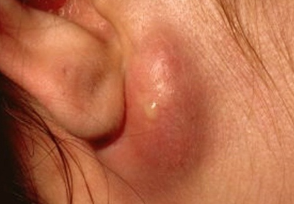귀뒤 피지낭종