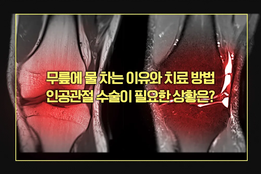 무릎에 물 차는 이유와 치료 방법