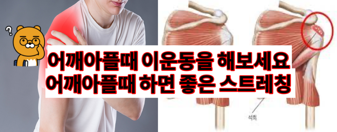  어깨 통증의 주된 원인 5가지 | 오십견 석회건염 어깨에 좋은 스트레칭(건강정보)