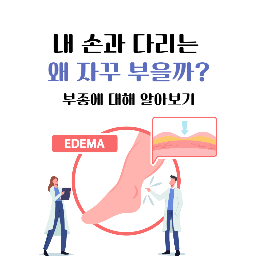  내 손과 다리는 왜 자꾸 부을까? 부종에 대해 알아보기
