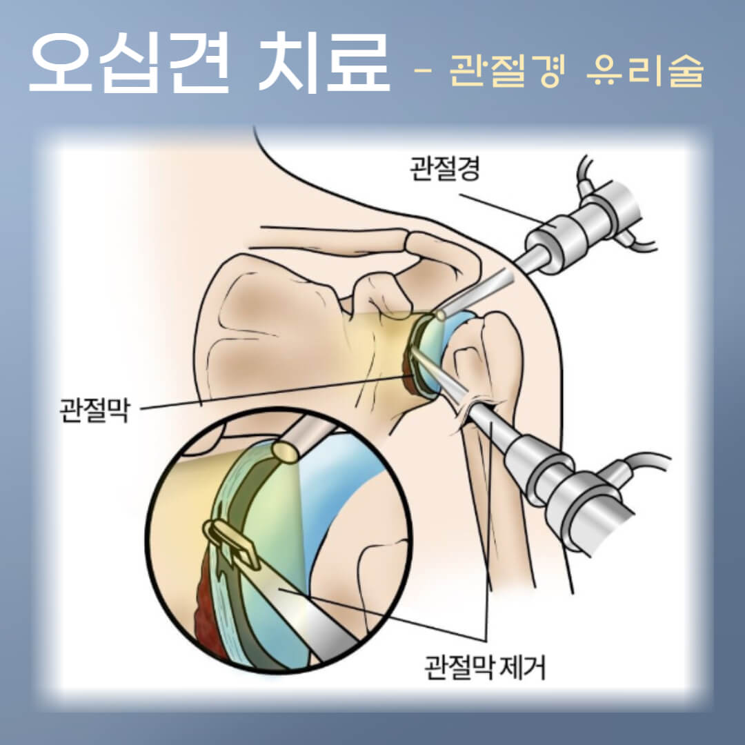 오십견 수술적 치료