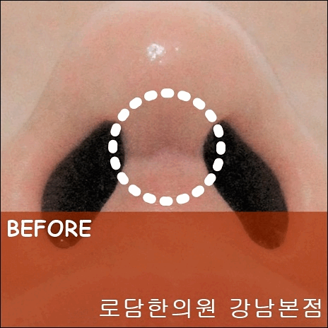 코흉터 수술자국 치료과정 로담한의원 새살침 코라테라피