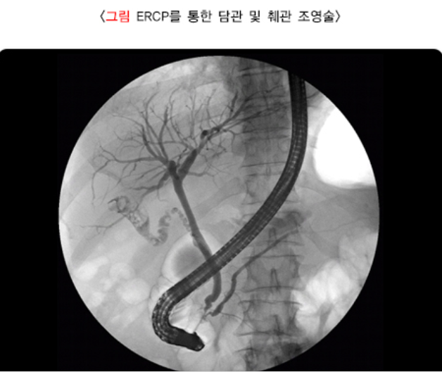 내시경적 역행성 담췌관조영술