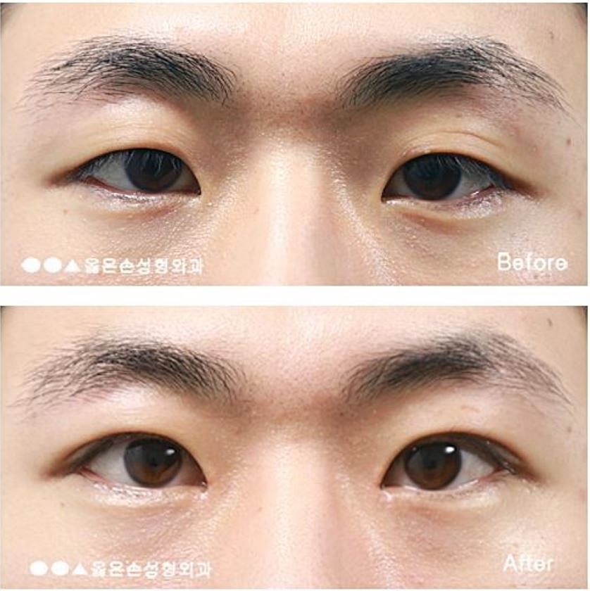 남자눈성형잘하는곳 단단한 눈매를