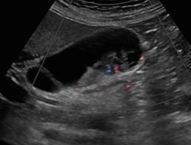 Gall bladder carcinoma (담낭암)