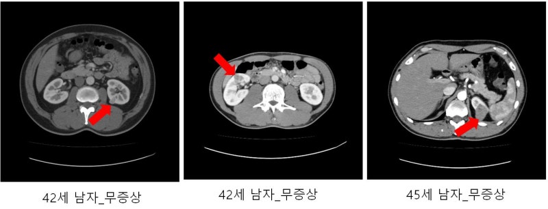 신장암 초기증상 및 3기·4기 생존율, 꼭 알아야 할 신장암 검사 치료 방법
