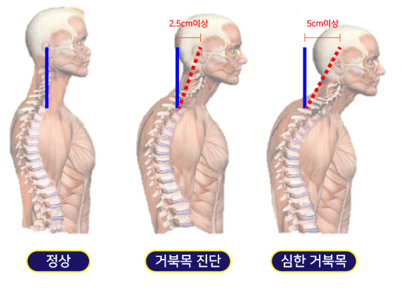 거북목 진단