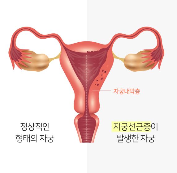 자궁선근증