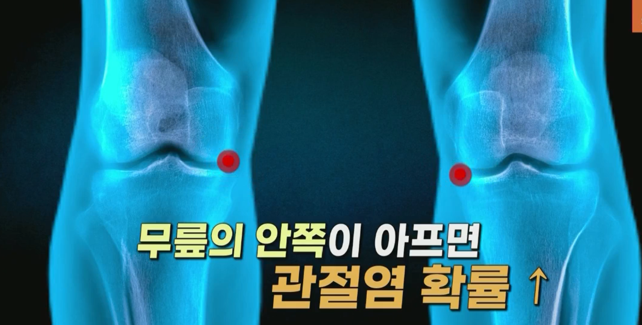  무릎관절염자가진단법 관절염파스사용법 관절오래쓰는법 겨울에더시리다 무릎관절염운동법 예방법 천기누설 546회 1209방송