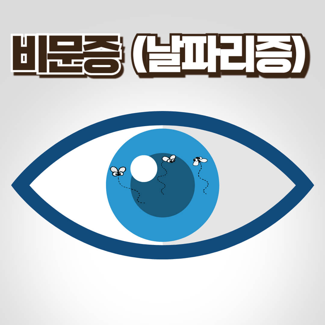 비문증(날파리증) 증상