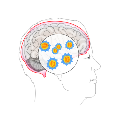  수막구균성 수막염(Meningococcal meningitis)