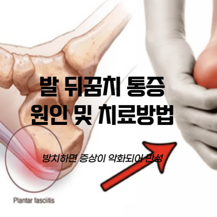 발 뒤꿈치 통증의 원인 및 치료관련 썸네일