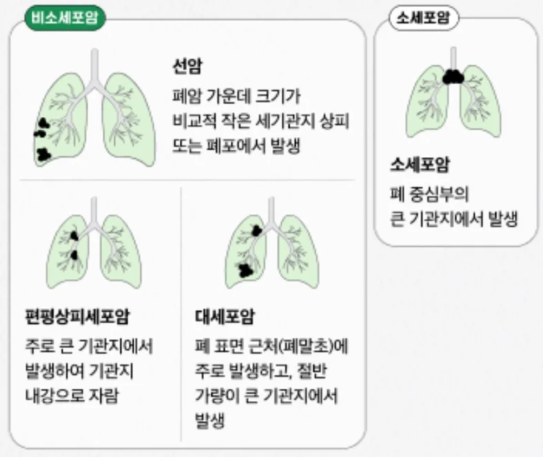 폐암 원인 폐암 종류 폐암 사망률 폐암 흡연 폐암 증상 폐암 검사 폐암 조기 발견 폐암 예방