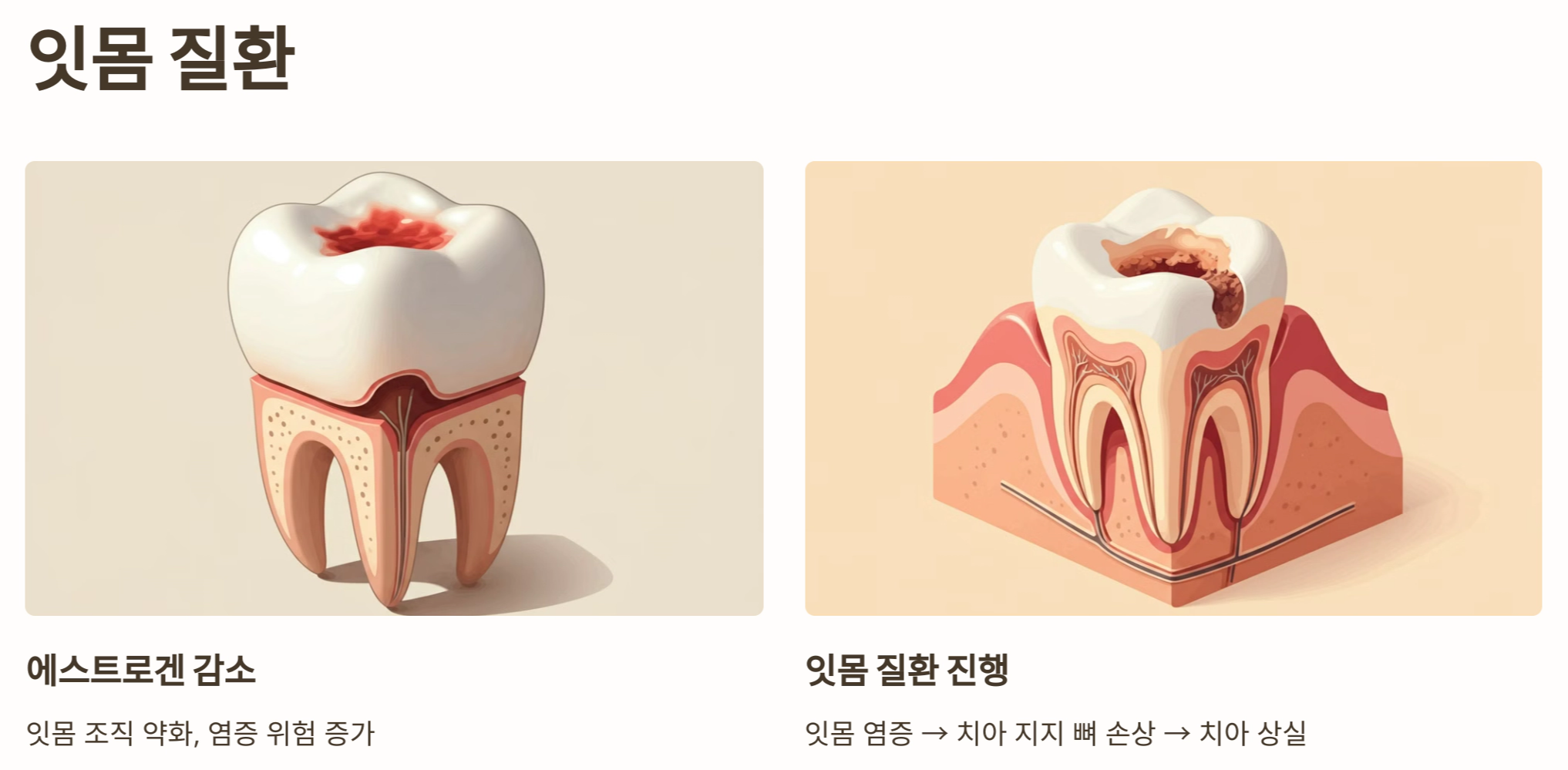 잇몸 질환