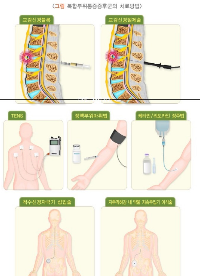 복합통증증후군